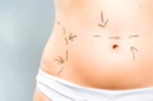 ist1 7819101 marks on abdomen for cosmetic surgery1