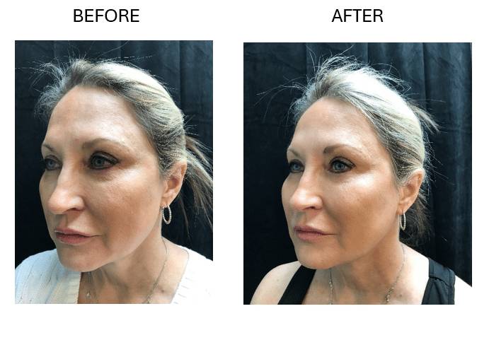 fat transfer b&a