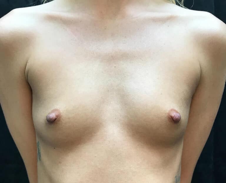 Before Image: Silicone Breast Augmentation - front