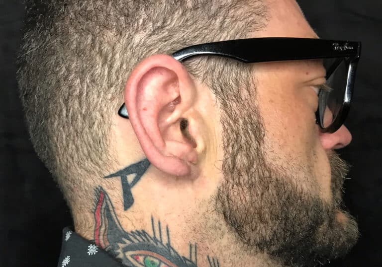 After Image: Ear Lobe Repair - right-side