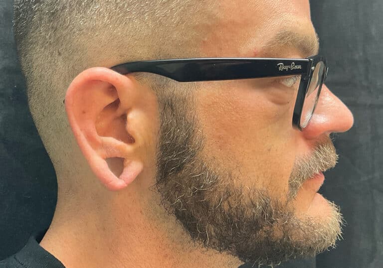 Before Image: Ear Lobe Repair - right-side