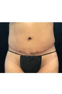 After Image: Abdominoplasty - front