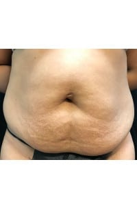 Before Image: Abdominoplasty - front