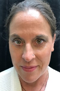 After Image: Blepharoplasty, Lower Lids - front