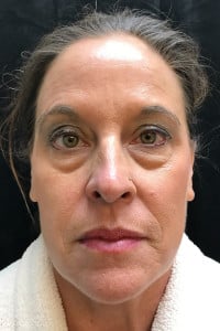 Before Image: Blepharoplasty, Lower Lids - front