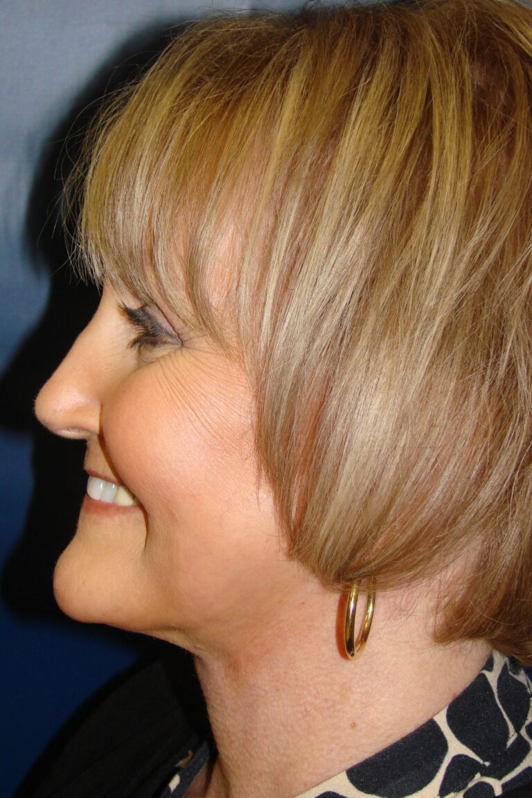 After Image: Face Lift - left-side