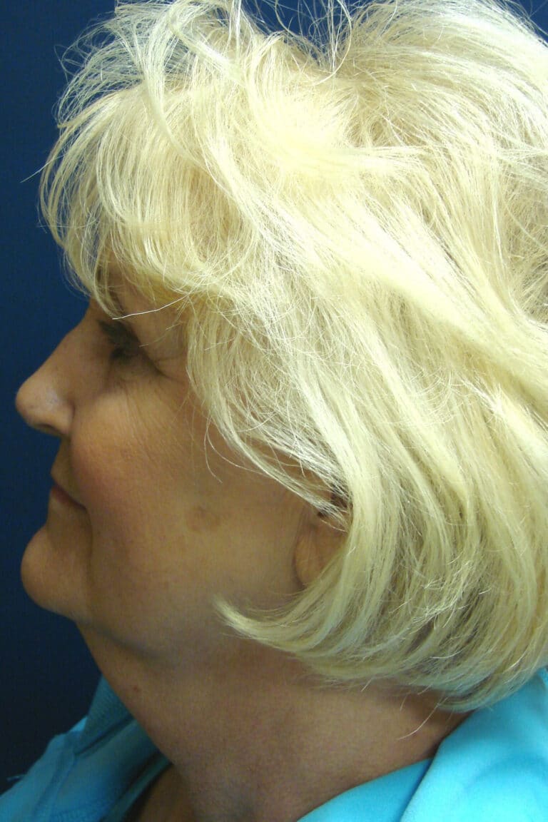 Before Image: Face Lift - left-side