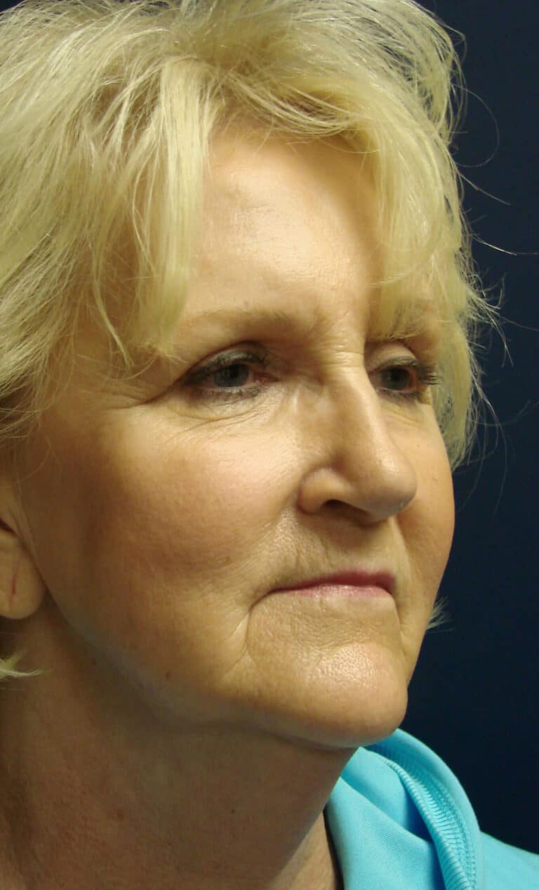 Before Image: Face Lift - right-front-oblique