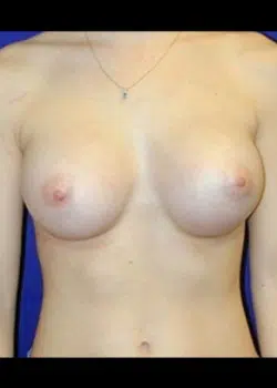 After Image: Silicone Breast Augmentation - front