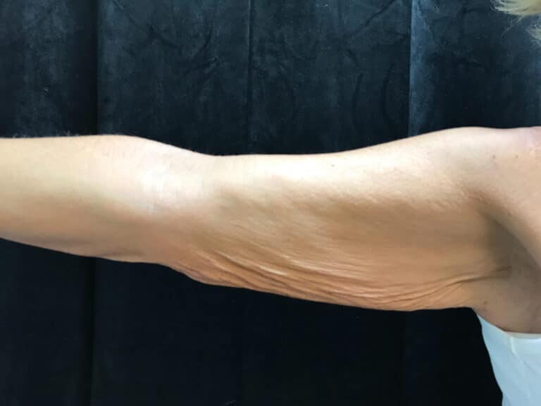 Before Image: Brachioplasty - front
