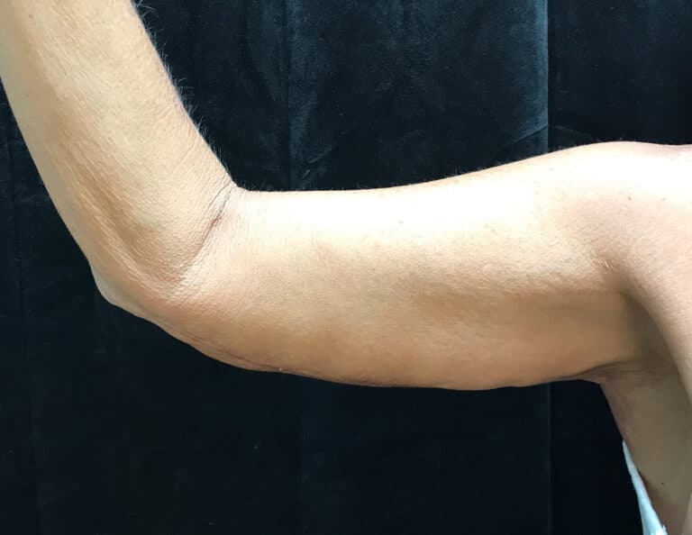After Image: Brachioplasty - front