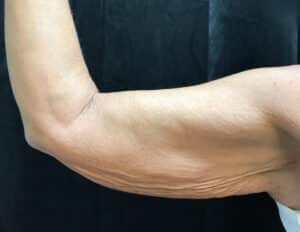 Before Image: Brachioplasty