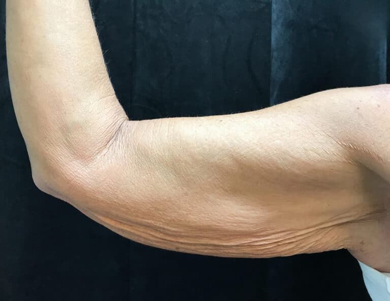 Before Image: Brachioplasty - front