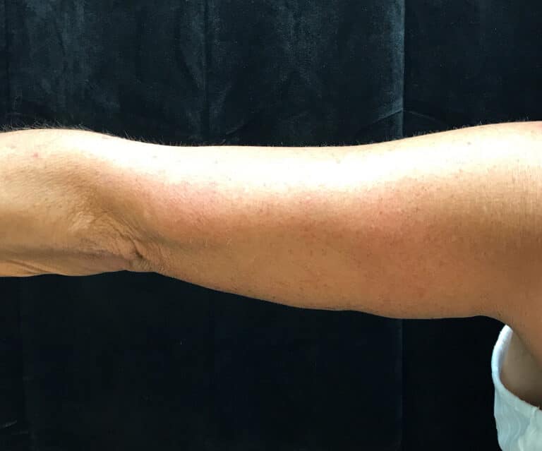 After Image: Brachioplasty - back