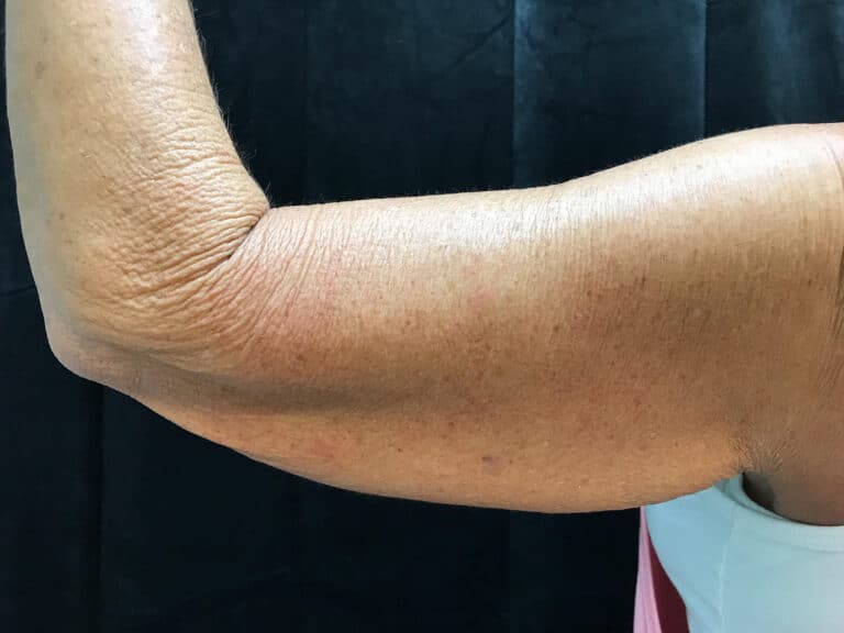 Before Image: Brachioplasty - back