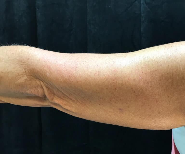 Before Image: Brachioplasty - back