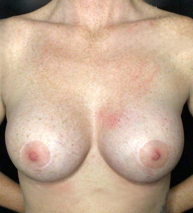 After Image: Silicone Breast Augmentation - front