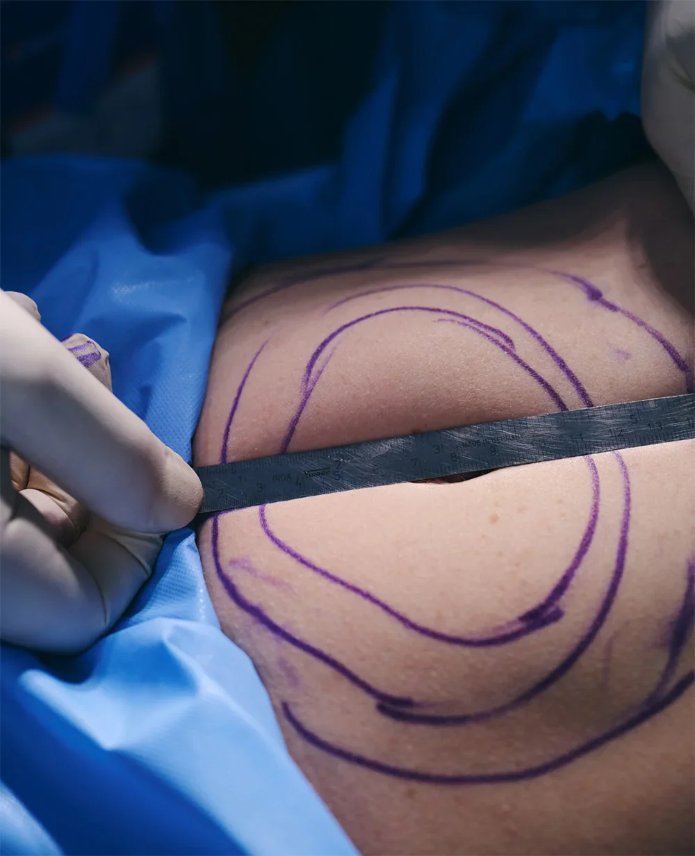 Surgeon marking patient's abdomen with purple lines for cosmetic surgery procedure in operating room - Body in Evansville, IN