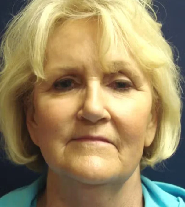 Real patient results in Evansville, IN Conkright Aesthetics