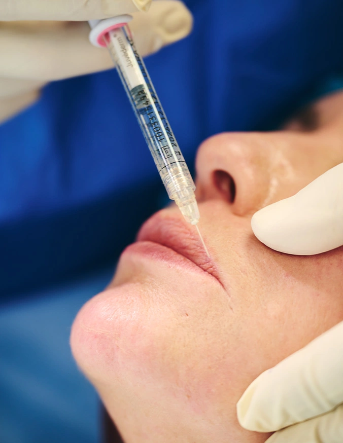 Medical professional performing dermal filler injection treatment on patient's lips with syringe - Dermal fillers in Evansville, IN