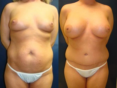 abdominoplasty-liposuction-1-site-saline-breast-implants 1-1