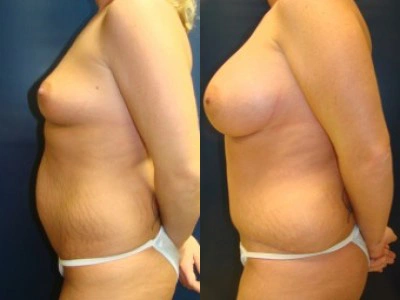 abdominoplasty-liposuction-1-site-saline-breast-implants 1-2