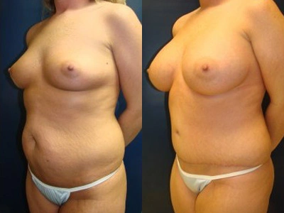 abdominoplasty-liposuction-1-site-saline-breast-implants 1-3