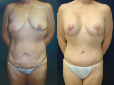 abdominoplasty-mastopexy-with-implants 2-1