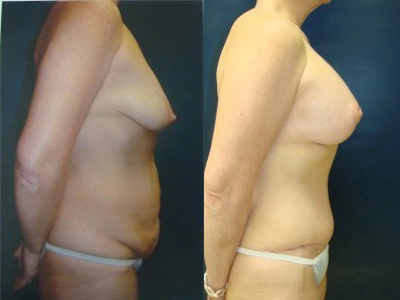 abdominoplasty-mastopexy-with-implants 2-2