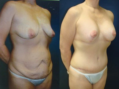 abdominoplasty-mastopexy-with-implants 2-3