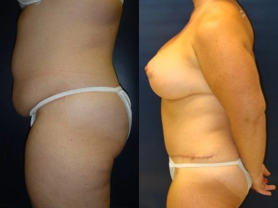 abdominoplasty-mastopexy-with-implants-3-1 3-4