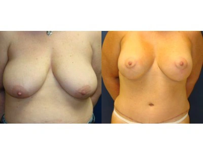 abdominoplasty-mastopexy-with-implants-3-1
