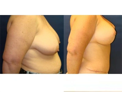 abdominoplasty-mastopexy-with-implants-3-2