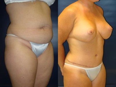 abdominoplasty-mastopexy-with-implants- 3-3