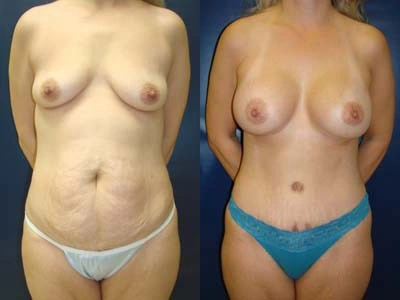 abdominoplasty-mastopexy-with-implants-bmi-23- 4-1