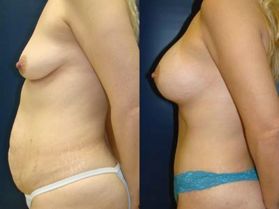 abdominoplasty-mastopexy-with-implants-bmi- 4-2