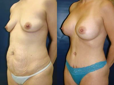 abdominoplasty-mastopexy-with-implants-bmi- 4-3