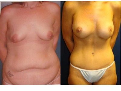 abdominoplasty-mastopexy-with-saline-implants 5-1
