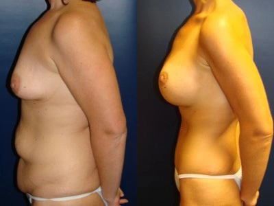abdominoplasty-mastopexy-with-saline-implants 5-2