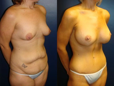 abdominoplasty-mastopexy-with-saline-implants 5-3