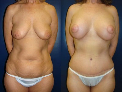 abdominoplasty-mastopexy-with-saline-implants-6-1