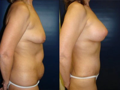 abdominoplasty-mastopexy-with-saline-implants-6-2