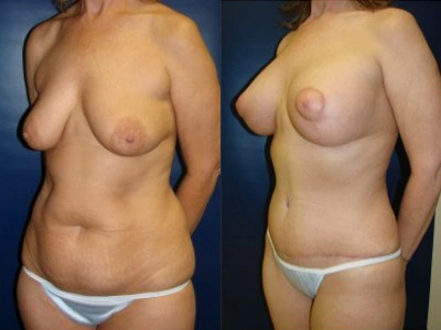 abdominoplasty-mastopexy-with-saline-implants-6-3