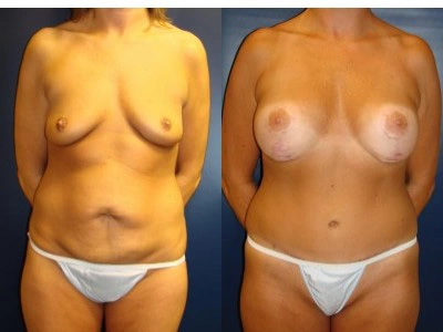 abdominoplasty-mastopexy-with-saline-implants-7-1