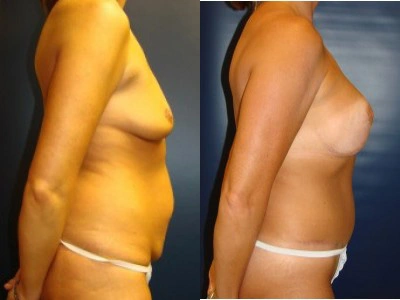 abdominoplasty-mastopexy-with-saline-implants-7-2