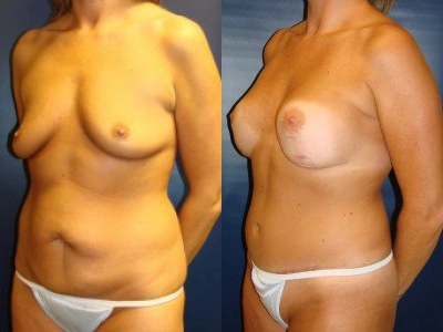 abdominoplasty-mastopexy-with-saline-implants-7-3
