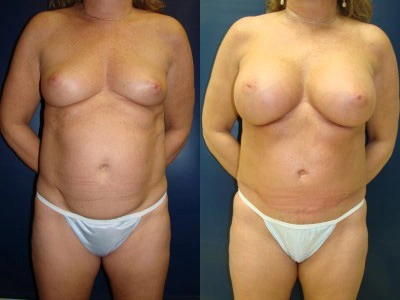 abdominoplasty-saline-breast-implants 8-1