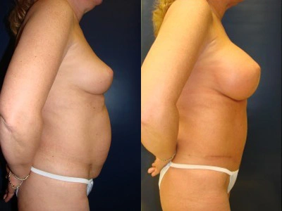 abdominoplasty-saline-breast-implants 8-2