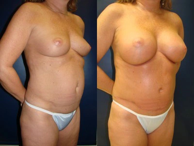 abdominoplasty-saline-breast-implants 8-3