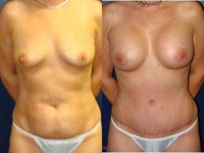 abdominoplasty-saline-breast-implants-9-1